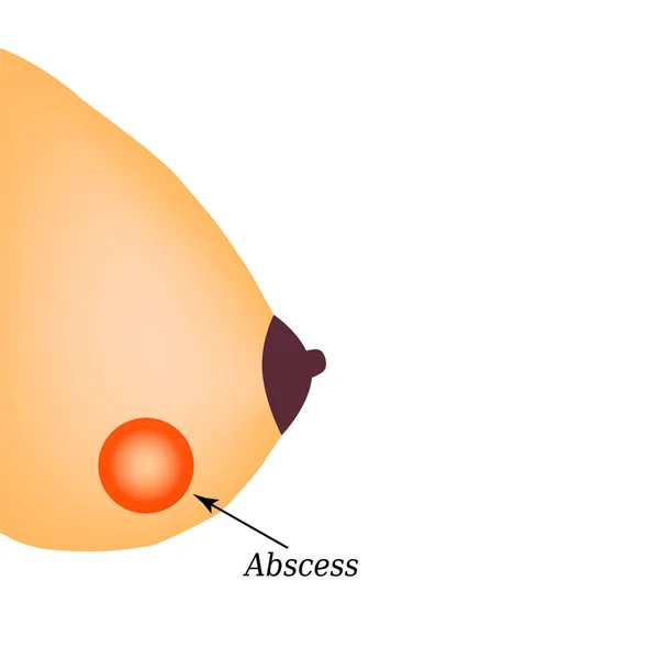 Ascesso nella ghiandola mammaria. Giornata mondiale del cancro al seno. Illustrazione vettoriale su sfondo isolato — Vettoriale Stock