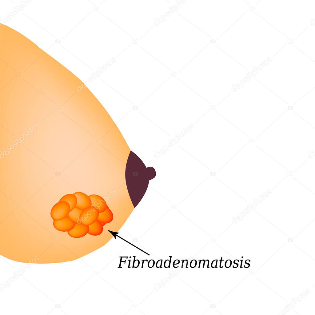 Fibrooadenomatosis in the mammary gland. World Breast Cancer Day. Vector illustration on isolated background