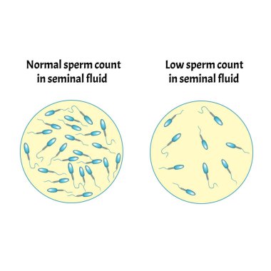 Sperm sayısı düşük. Boşalıktaki sperm miktarı çok azdı. Erkek kısırlığı Oligospermia. Spermogram. Patoloji tipleri. Sperm kusurları. Spermin yapısı. Bilgi Grafikleri Vektörü.