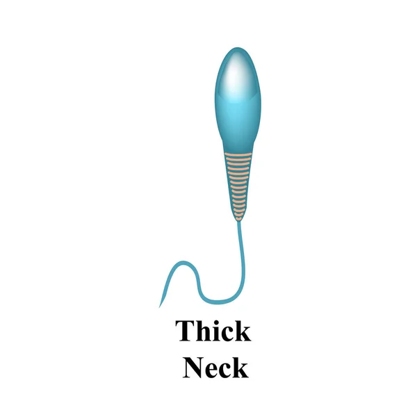 Formas patológicas de esperma no ejaculado. Infertilidade masculina Oligospermia. Espermograma. Defeitos do esperma. Infográficos. Ilustração vetorial sobre fundo isolado . —  Vetores de Stock