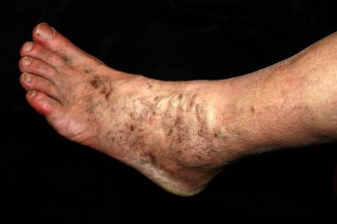 Bacak. Varis. Flebeurysm. Tromboflebit. damarlarda bacak.