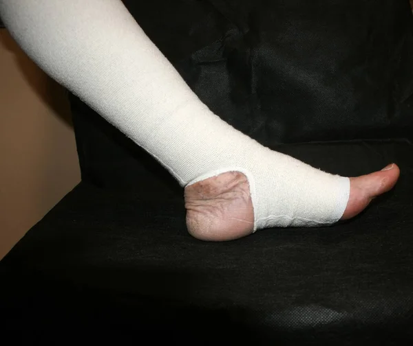 Leg. Varicose, veins. Phlebeurysm. Thrombophlebitis. Elastic bandage. — Stock Photo, Image