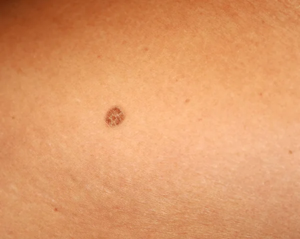 Brown spots on the skin. Spot dark.