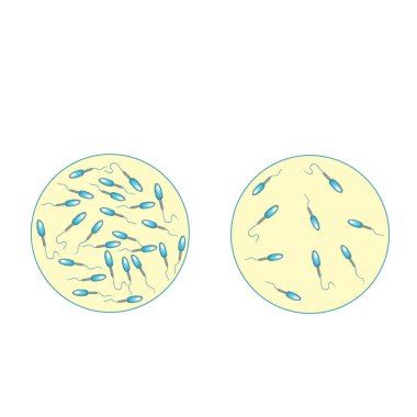 Sperm sayısı düşük. Boşalıktaki sperm miktarı çok azdı. Erkek kısırlığı Oligospermia. Spermogram. Patoloji tipleri. Sperm kusurları. Spermin yapısı. Bilgi Grafikleri Vektörü.