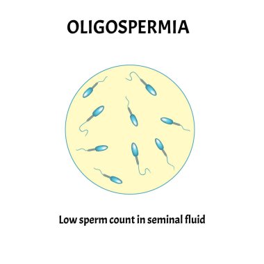 Sperm sayısı düşük. Boşalıktaki sperm miktarı çok azdı. Erkek kısırlığı Oligospermia. Spermogram. Patoloji tipleri. Sperm kusurları. Spermin yapısı. Bilgi Grafikleri Vektörü.
