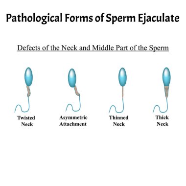 Boşalan spermin patolojik formları. Erkek kısırlığı Oligospermia. Spermogram. Kafanın patolojisi. Sperm kusurları. Bilgi grafikleri. İzole edilmiş arkaplanda vektör illüstrasyonu.
