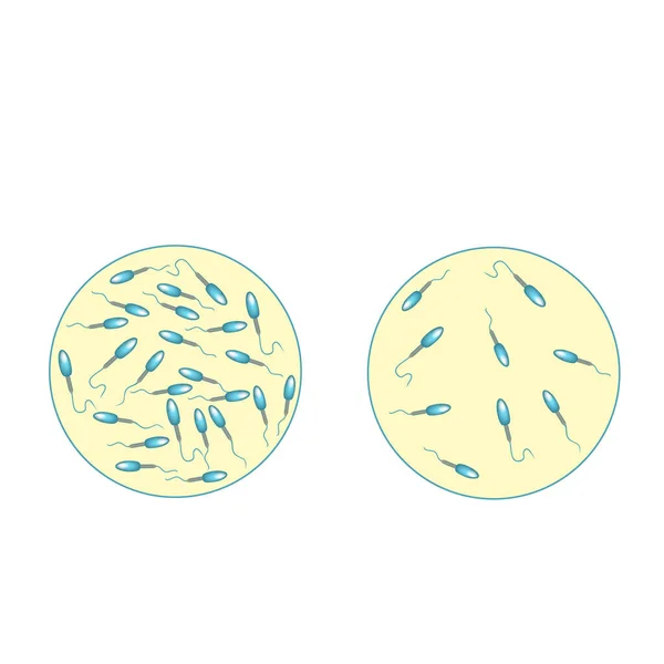 Bajo recuento de espermatozoides en líquido seminal. Baja abundancia de esperma en la eyaculación. Infertilidad masculina Oligospermia. Espermograma. tipos de patología. Defectos de esperma. estructura del esperma. Vector de infografías . — Vector de stock