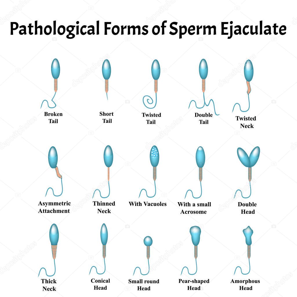 Pathological forms of sperm in the ejaculate. Male infertility Oligospermia. Spermogram. Sperm pathology types. Sperm defects. Infographics. Vector illustration on isolated background.