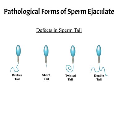 Boşalan spermin patolojik formları. Erkek kısırlığı Oligospermia. Spermogram. Kuyruğun patolojisi. Sperm kusurları. Bilgi grafikleri. İzole edilmiş arkaplanda vektör illüstrasyonu.