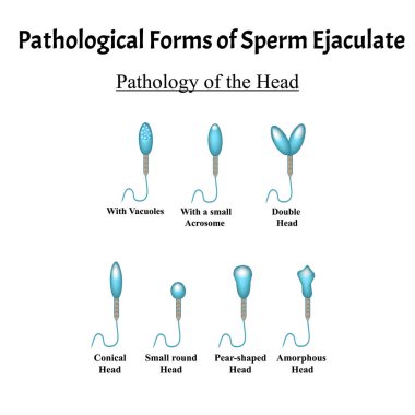 Boşalan spermin patolojik formları. Erkek kısırlığı Oligospermia. Spermogram. Kafanın patolojisi. Sperm kusurları. Bilgi grafikleri. İzole edilmiş arkaplanda vektör illüstrasyonu.
