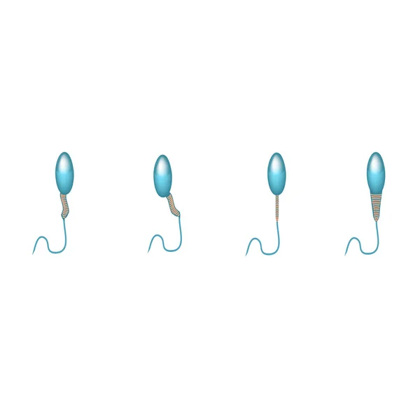 Patologiska former av sperma i ejakulatet. Manlig infertilitet Oligospermi. Spermogram. Huvudets patologi. Spermiedefekter. Infografik. Vektor illustration på isolerad bakgrund. — Stock vektor