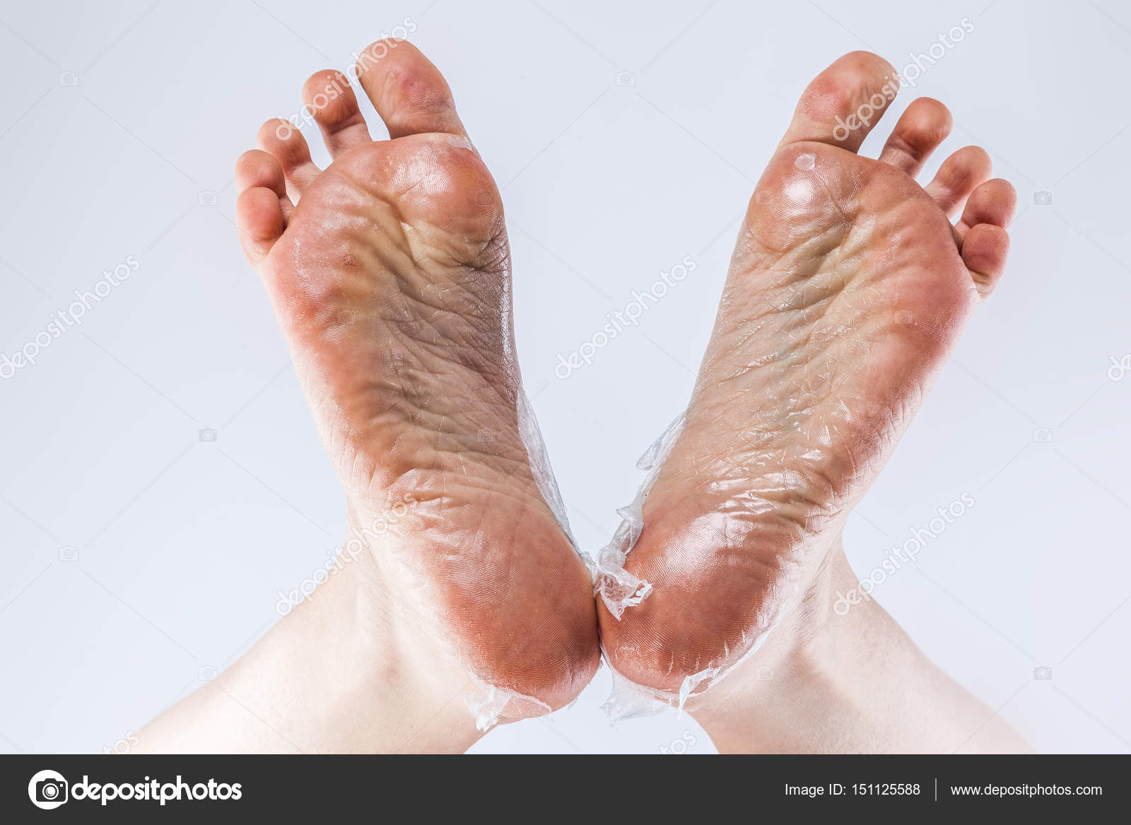 Dehydrated skin on feet — Stock Photo © #151125588