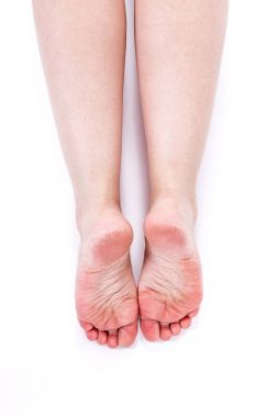dehydrated skin on feet clipart