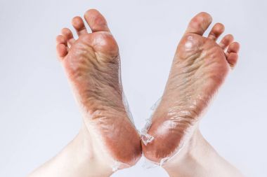 dehydrated skin on feet clipart