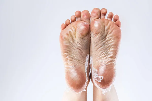 Αφυδατωμένο δέρμα στα πόδια — Φωτογραφία Αρχείου