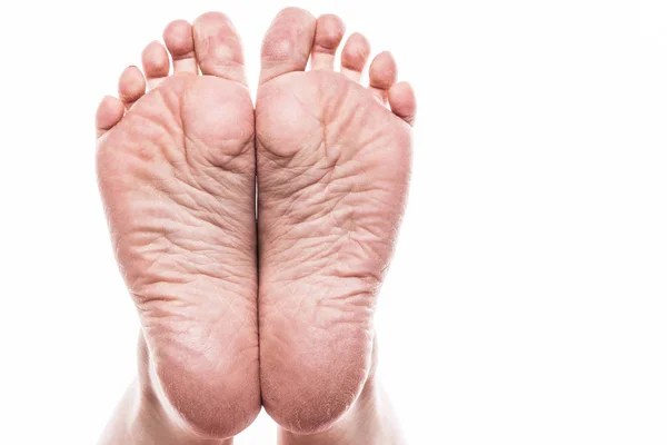 Gedehydrateerde huid op voeten — Stockfoto