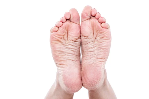 Dehydrated skin on feet — Stock Photo, Image