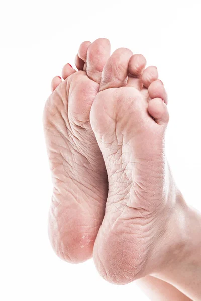 足の乾燥肌 — ストック写真