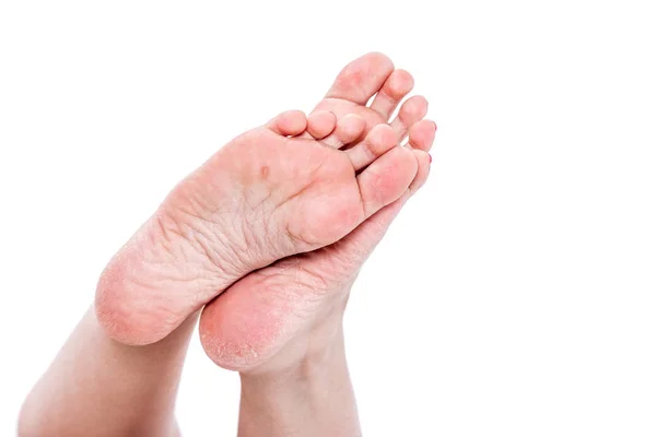 Dehydrated skin on feet — Stock Photo, Image