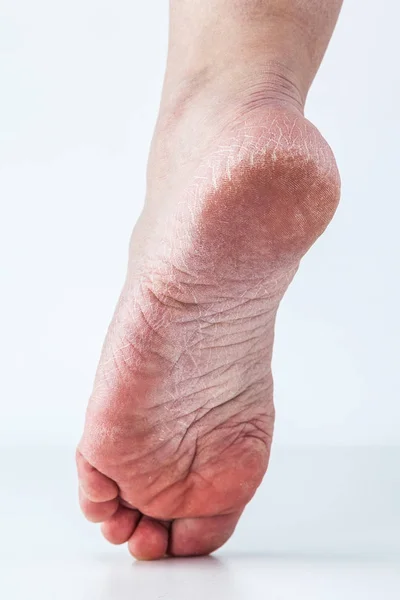 Зневоднена шкіра пішки — стокове фото