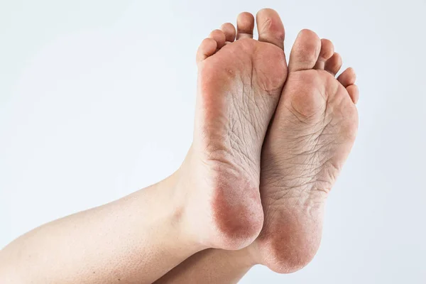 Обезвоженная кожа на ногах — стоковое фото