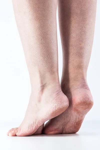 Wysuszona skóra na stopach — Zdjęcie stockowe