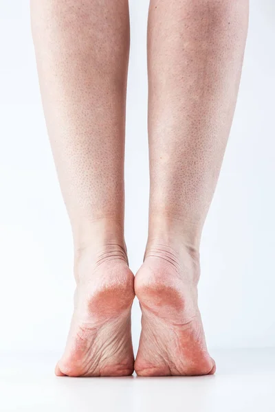 Pelle disidratata su piedi — Foto Stock