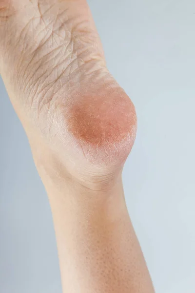 Pele desidratada a pé — Fotografia de Stock