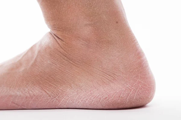 Dehidratált bőr a láb — Stock Fotó