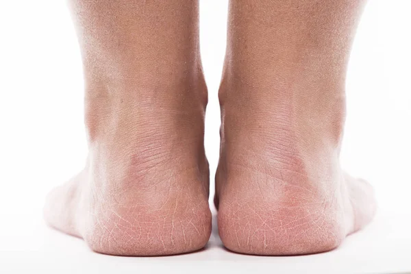 Dehydrated skin on feet — Stock Photo, Image