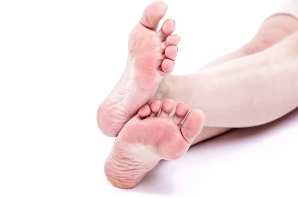 Wysuszona skóra na stopach — Zdjęcie stockowe