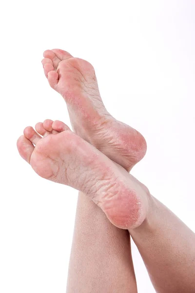 Peau déshydratée sur les pieds — Photo