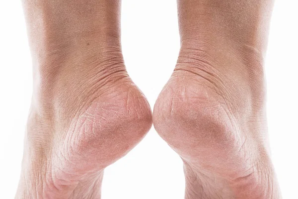 Обезвоженная кожа на ногах — стоковое фото