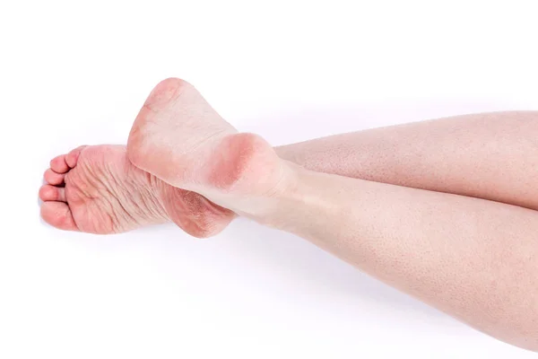 Dehidratált bőr a láb — Stock Fotó
