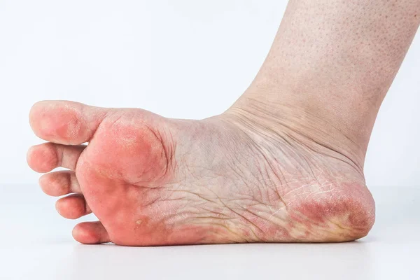 Pelle disidratata a piedi — Foto Stock