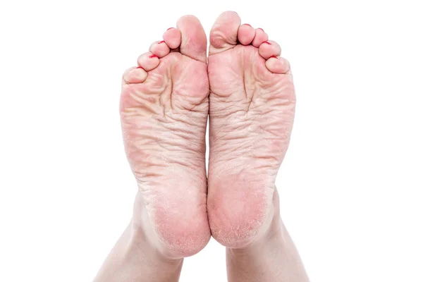 足の乾燥肌 — ストック写真