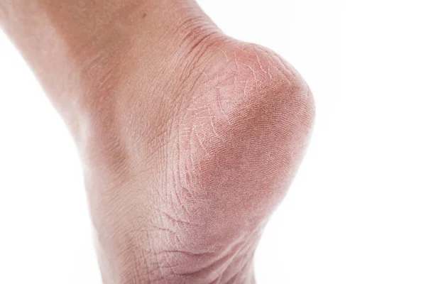 Αφυδατωμένο δέρμα με τα πόδια — Φωτογραφία Αρχείου
