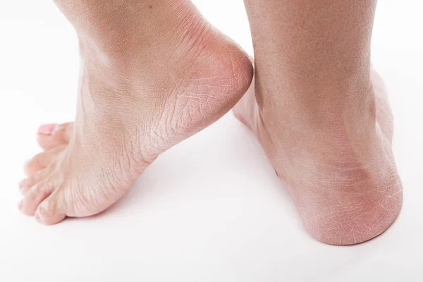 Dehydrierte Haut an den Füßen — Stockfoto