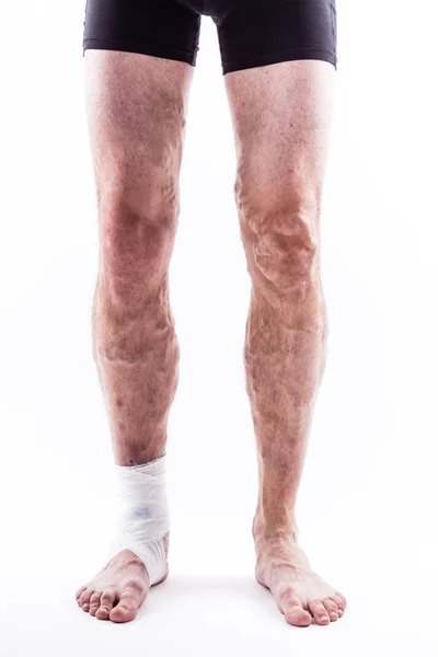 Human legs with blocked veins — Stock Photo, Image