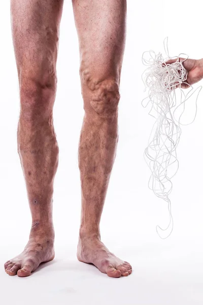 Человеческая нога с заблокированными венами и веревкой — стоковое фото