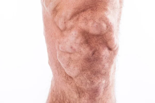 Human leg with blocked veins — Stock Photo, Image