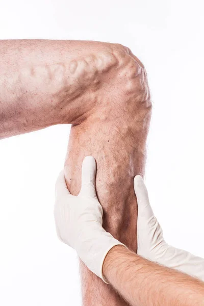 Doctor examines leg with blocked veins — Stock Photo, Image