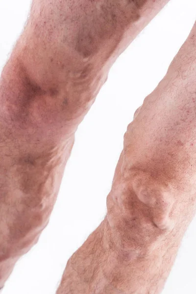 Jambes humaines avec veines bloquées — Photo