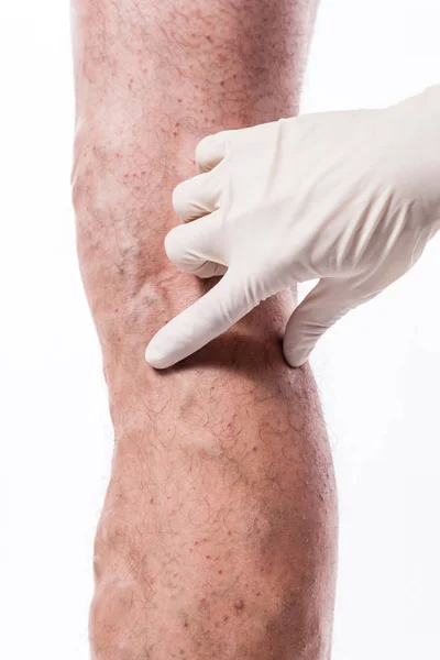 Doctor examines leg with blocked veins — Stock Photo, Image