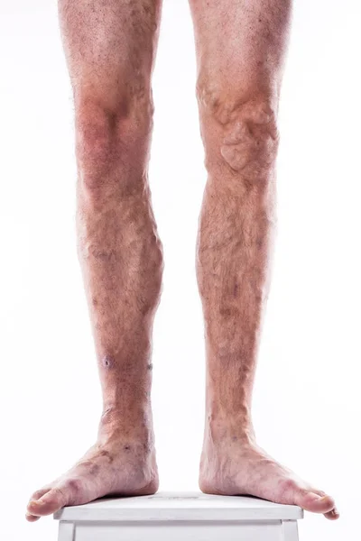 Human legs with blocked veins — Stock Photo, Image