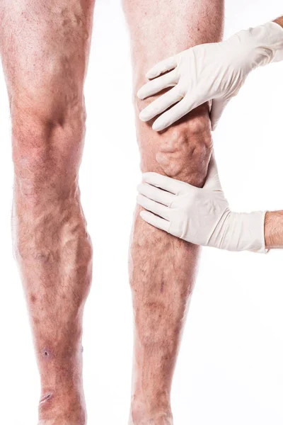Doctor examines leg with blocked veins — Stock Photo, Image