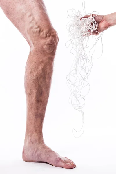 Pierna humana con las venas bloqueadas y la cuerda — Foto de Stock