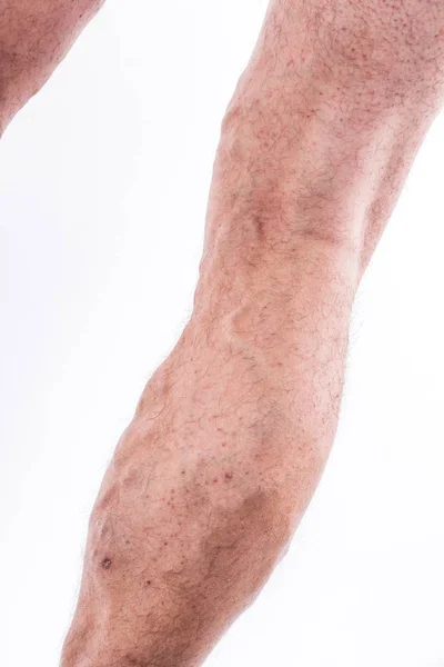 Human leg with blocked veins — Stock Photo, Image