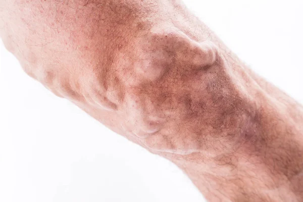 Menschliches Bein mit verstopften Venen — Stockfoto