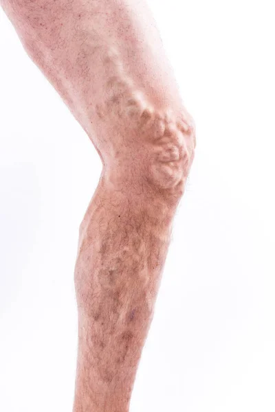 Человеческая нога с заблокированными венами — стоковое фото